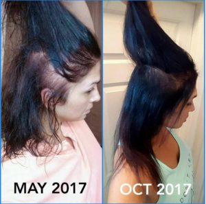 Hypothyroidism and Hair Loss